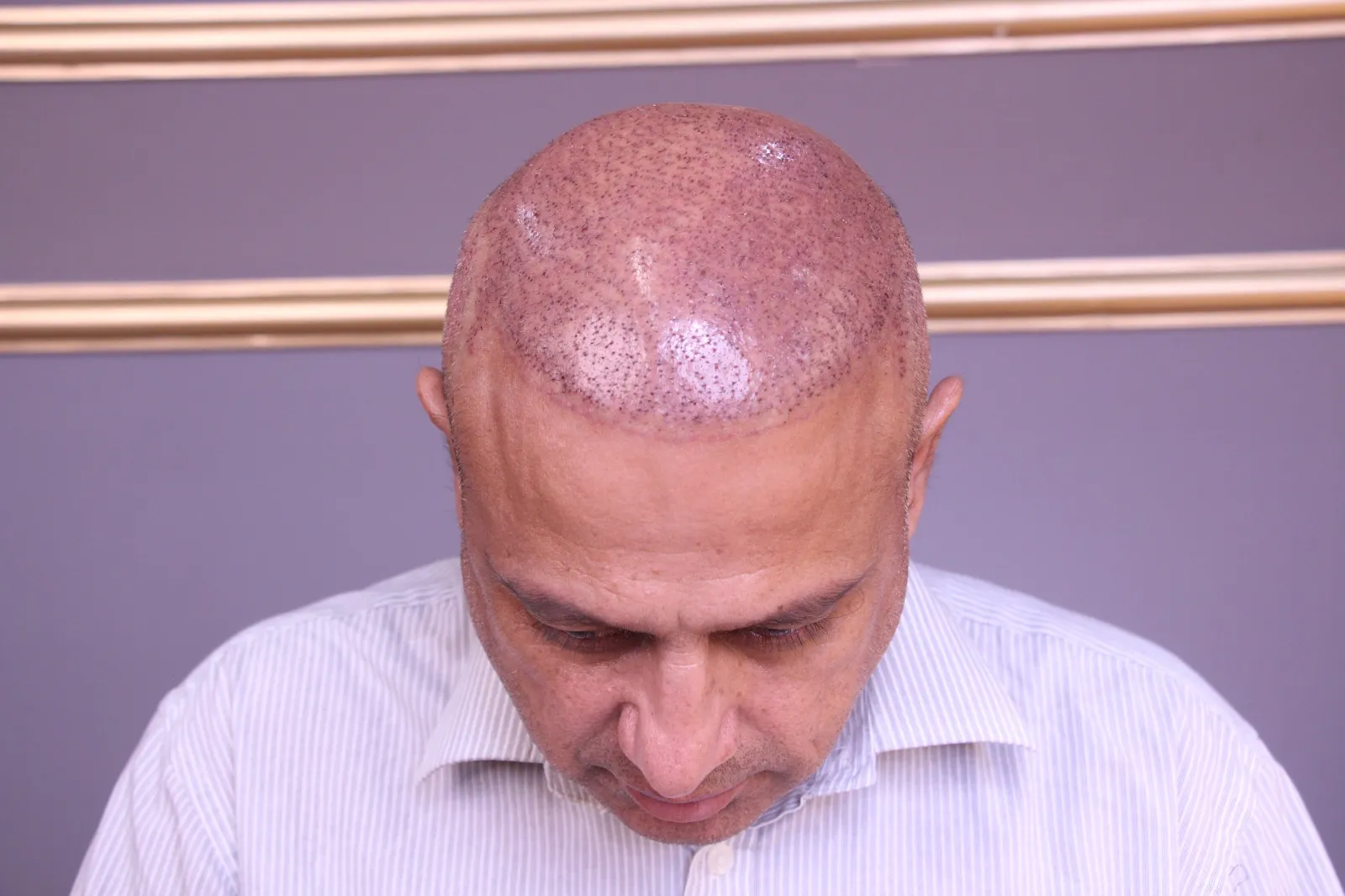 Choosing the Right Hair Transplant UK Clinic for You