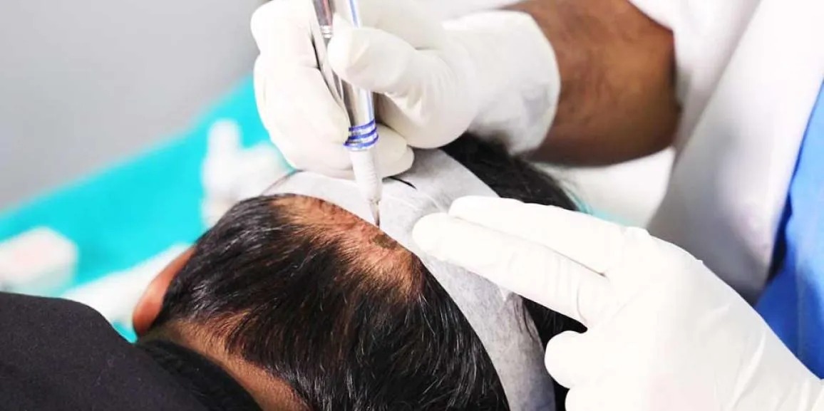Hair Transplant Istanbul Services at Sapphire Hair Clinic